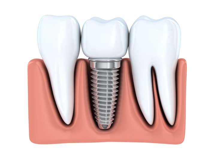 DENTAL IMPLANTS, cerec, san diego