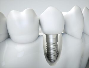 dental implant