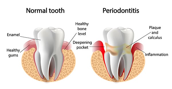 gum disease stages